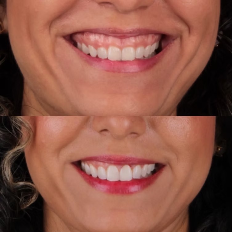 Transformação do sorriso - Paciente 2